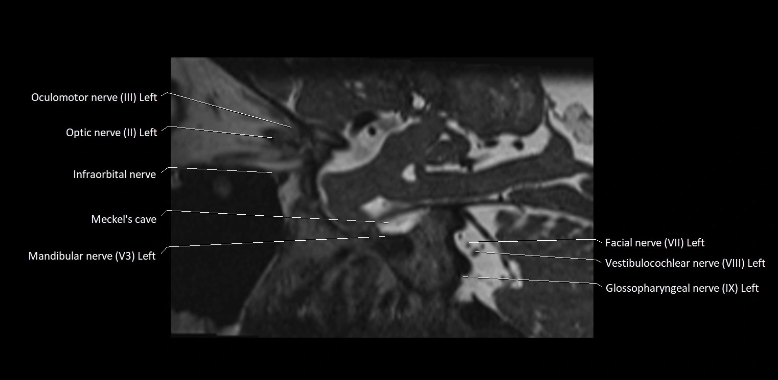 Cranial nerve sagittal anatomy MRI 3T image 16.webp